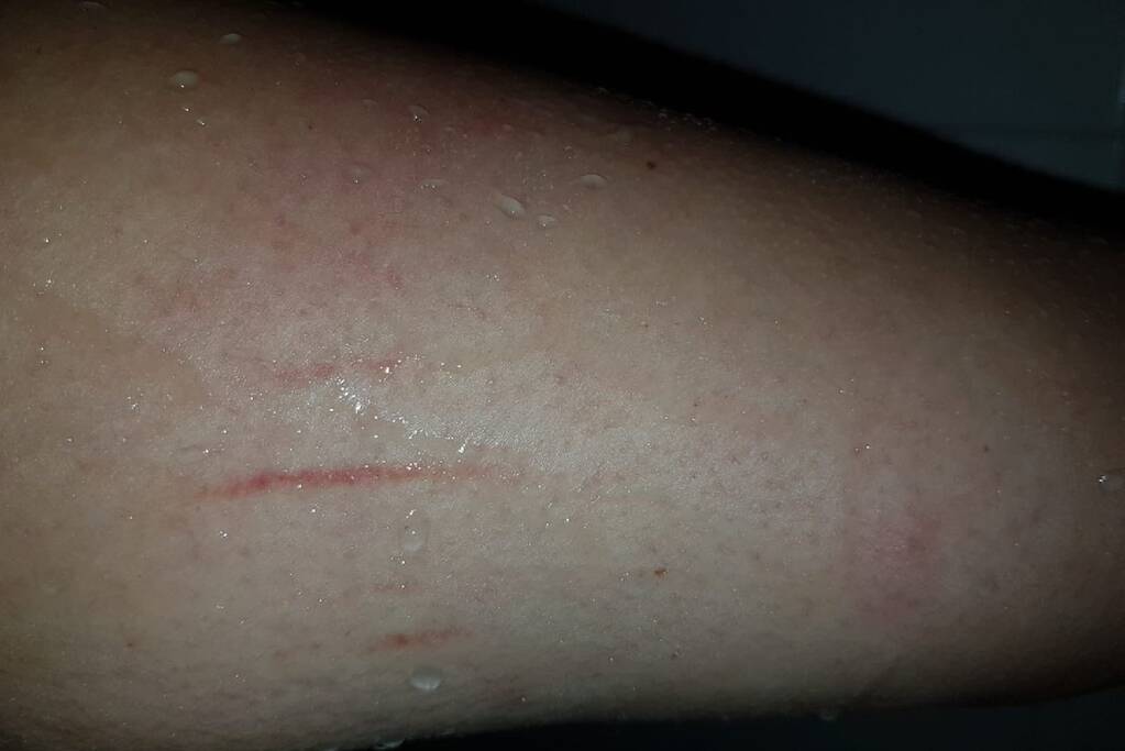 Neergestoken vrouw doet haar verhaal