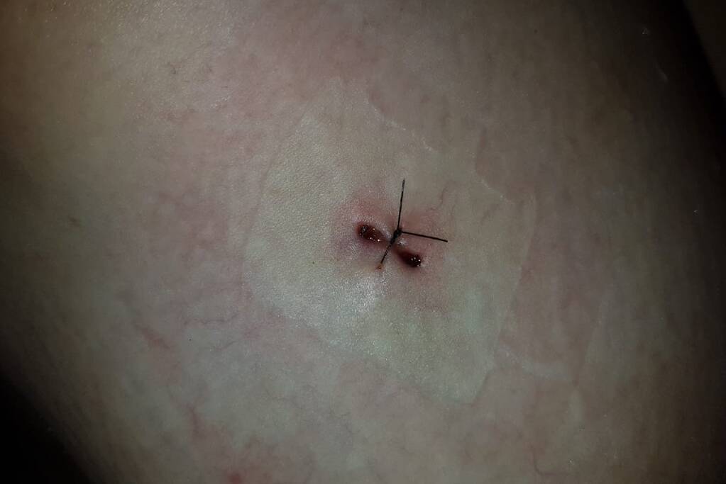 Neergestoken vrouw doet haar verhaal