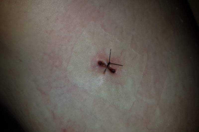 Neergestoken vrouw doet haar verhaal